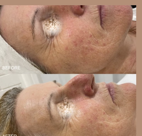 Before and after - B&A 1 Qi Beauty Facial