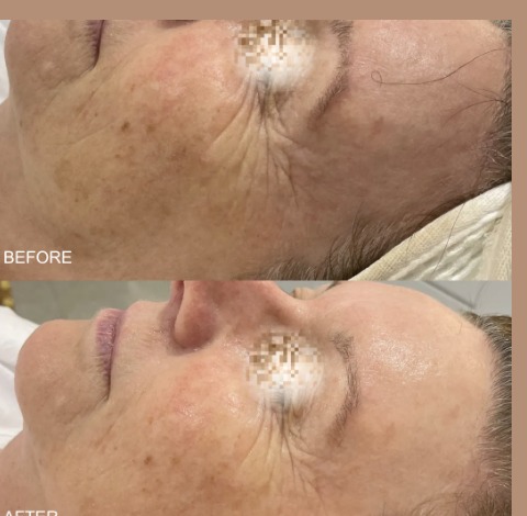 Before and after - B&A 1 Qi Beauty Facial